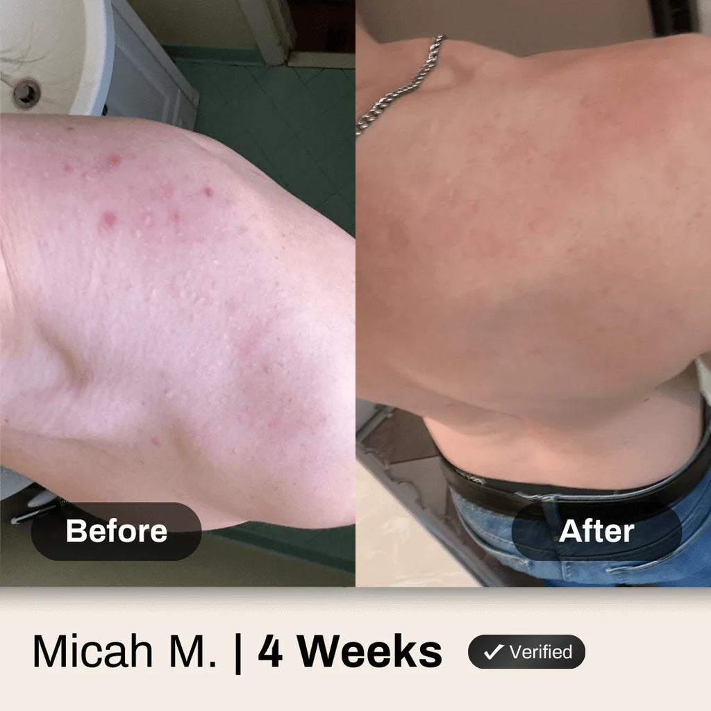 Shield Body Acne Wash