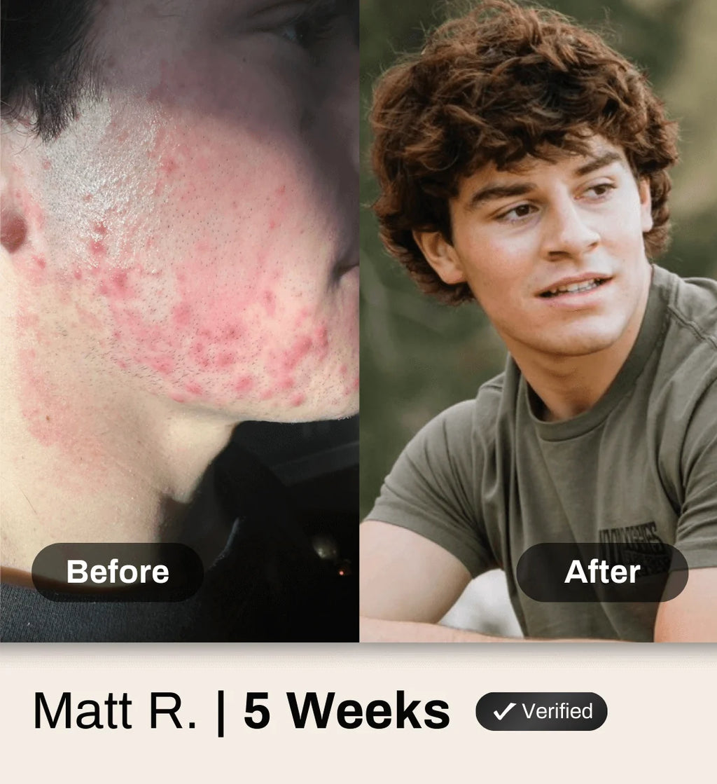 Shield Clear Skin System