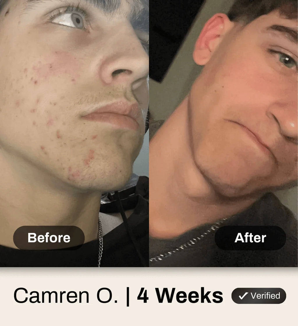 Shield Clear Skin System